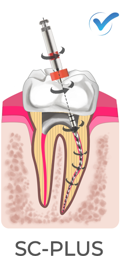 sc-plus Comply with the inherent anatomy of the root canal